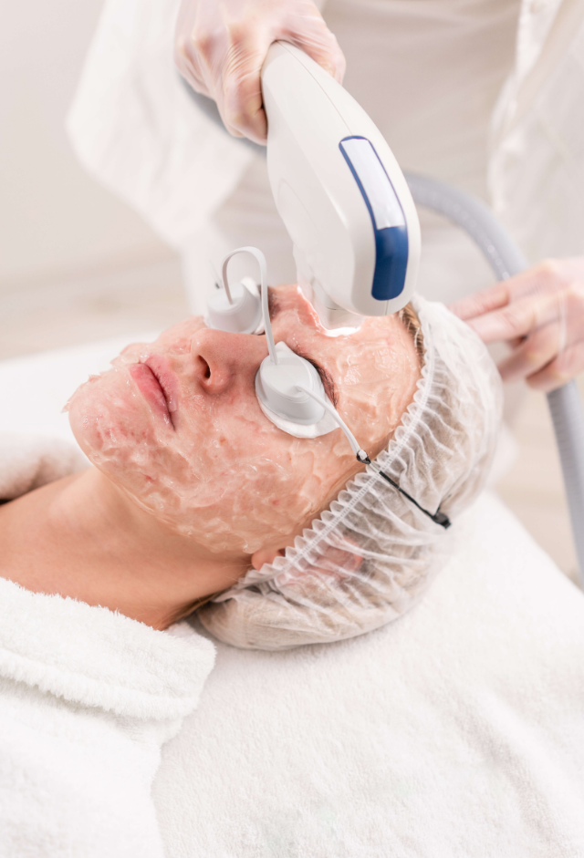 IPL Photofacial Treatment