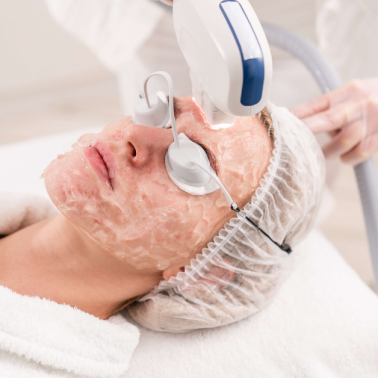 Benefits of IPL Photofacial