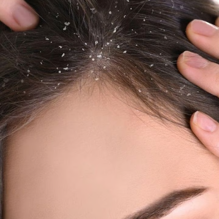 Scalp Health & Dandruff Control